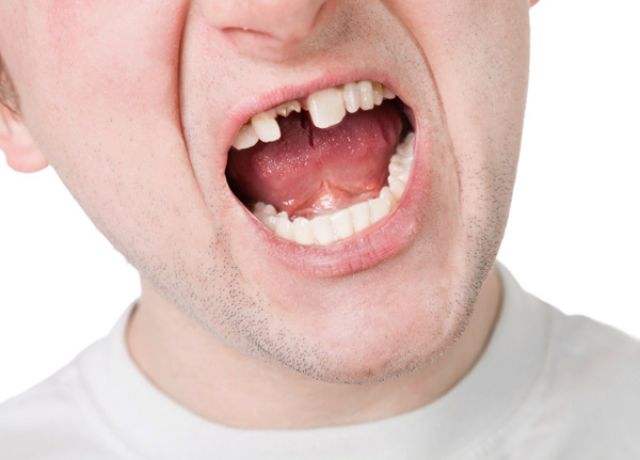 牙齒缺失原因