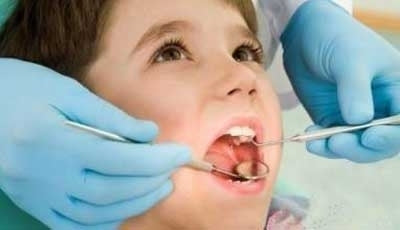 兒童蛀牙嚴重要補牙嗎