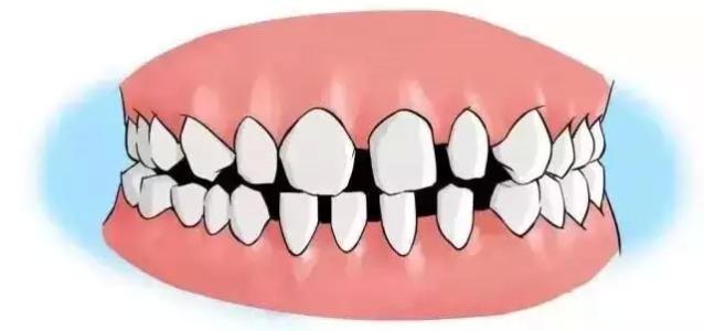 牙齒稀疏危害