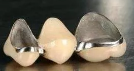 烤瓷牙和全瓷牙有什麽區別？你選錯了嗎？