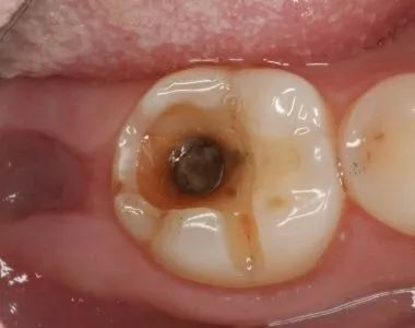 牙齒都爛咗一半，爲何不能直接補牙？